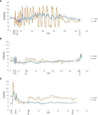 Anesthesia and Outcome of 33 Surgeries in 24 Multiple Endocrine Neoplasia Type 2A (MEN2A) Patients: A National Rare Disease Center’s Experience